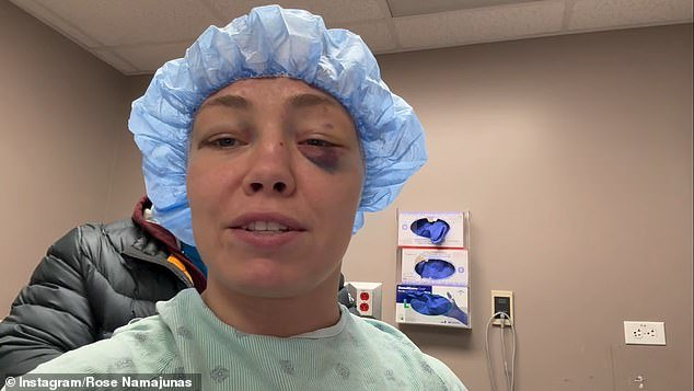 La estrella de UFC no pudo estornudar ni sonarse la nariz durante tres meses después de sufrir horribles lesiones en los ojos