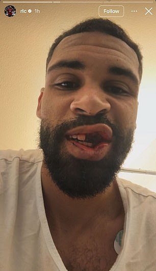 Ruben Loftus-Cheek comparte una imagen horrible después de perder varios dientes y sufrir una fractura de mandíbula, mientras la estrella de Inglaterra rompe el silencio sobre la lesión