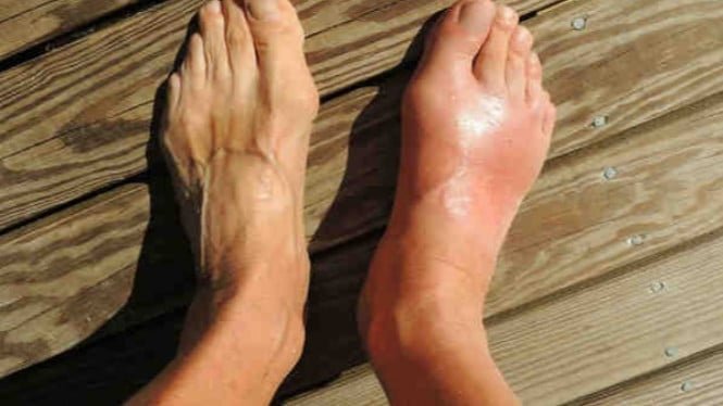 Estos dos ingredientes naturales, que provocan un dolor intenso, pueden resultar útiles para controlar la gota.