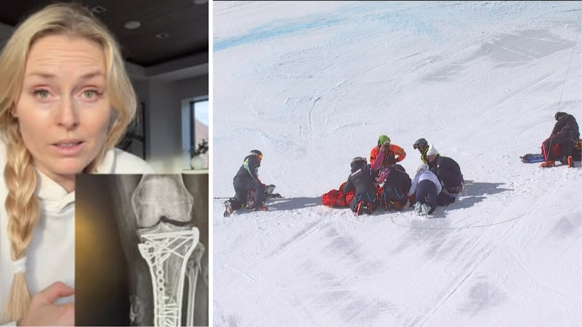 Lindsey Vonn dice que la cirugía la salvó de la amputación de la pierna izquierda