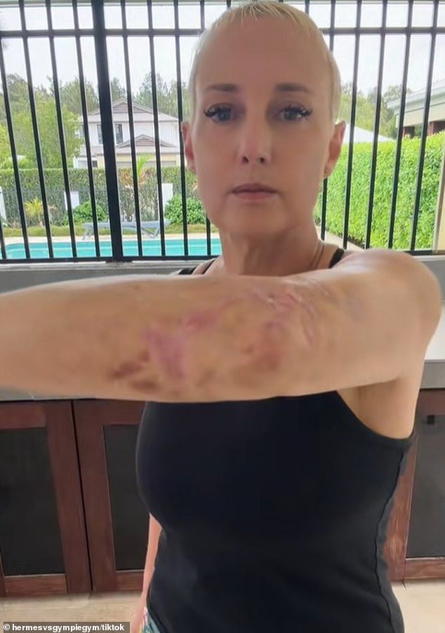 Mujer australiana revela sus horribles heridas cuatro años después de enfrentarse a la planta más dolorosa del mundo