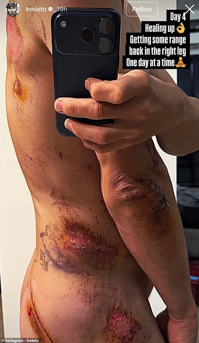 Un ciclista campeón publica una foto desnudo para revelar las cicatrices del brutal accidente que lo vio chocar con una señal de tráfico y un ciclista rival