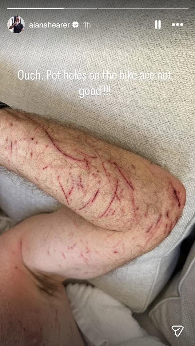 La leyenda inglesa Alan Shearer comparte horribles fotos de cortes en su brazo y pierna después de caerse de su bicicleta