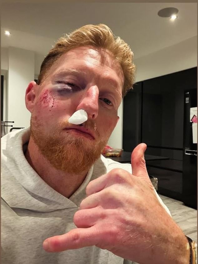 Ben Stokes sufre un revés en el camino para regresar de una terrible lesión facial mientras el cirujano le da malas noticias antes de la temporada del Campeonato del Condado