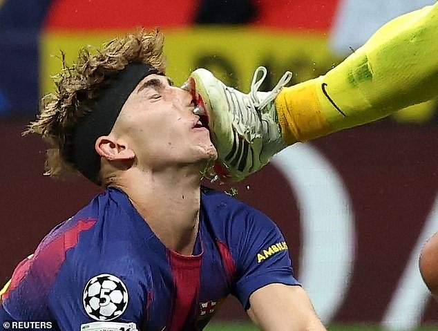 La estrella del Barcelona quedó sangrando en el campo en escenas horribles después de recibir una patada en la CARA por parte del portero del Atlético de Madrid durante el dramático partido de vuelta de la Liga de Campeones.